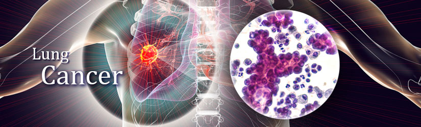 Lung Cancer Tumor Markers