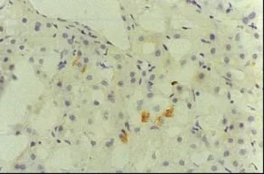 Anti-Hepatitis C virus Core Antigen antibody [H6-29] used in Immunohistochemistry (IHC). GTX64113